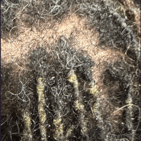 Advanced Scalp Recovery Series at Ms-Vee  Reels in Stone Mountain, GA